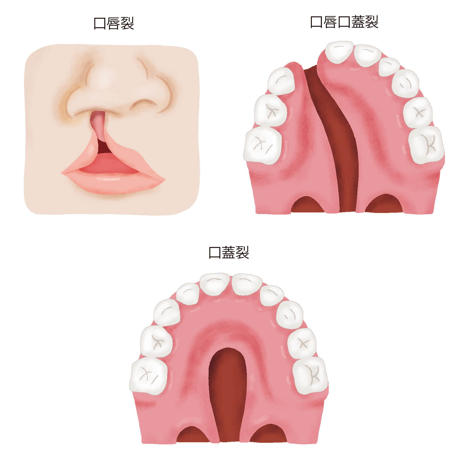 口唇口蓋裂 エコー 特徴 _ 口唇口蓋裂 写真 – OHEUOY