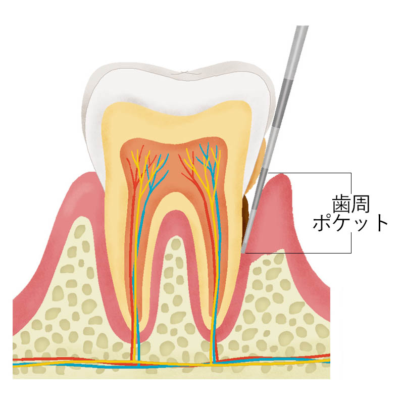 歯周ポケット | 歯科用語