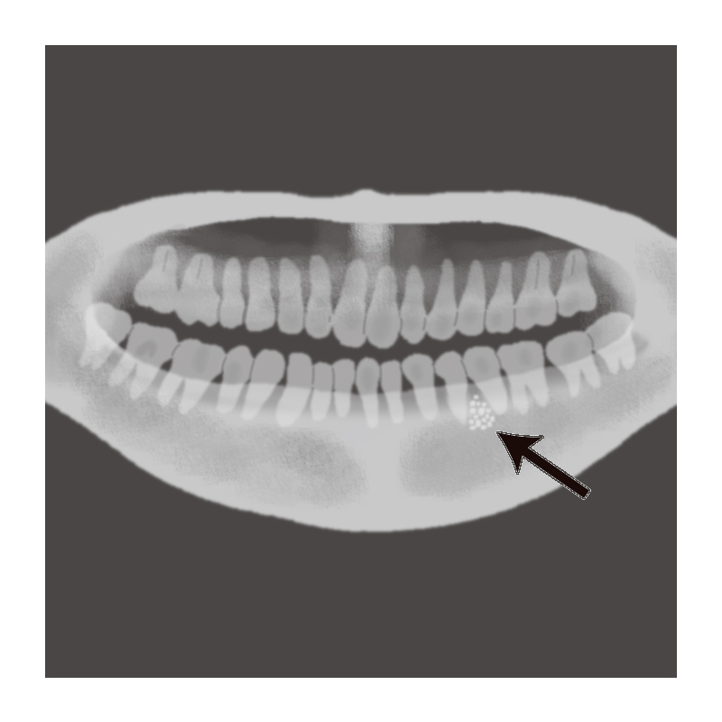 歯牙腫 歯科用語